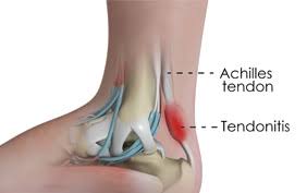 Cum se tratează inflamația tendoanelor și ligamentelor piciorului și gleznei?
