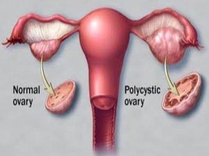 sindromul ovarului polichistic cum să piardă în greutate suplimente de pierdere în greutate braziliană
