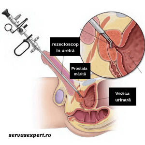 adenom prostata operatie