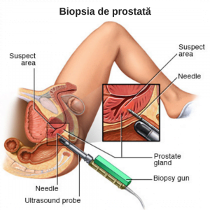 probele de prostata varicoza)
