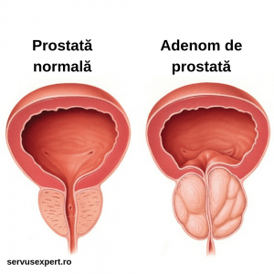 prostată și vedere)
