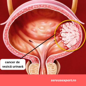 cancerul vezicii urinare simptome)