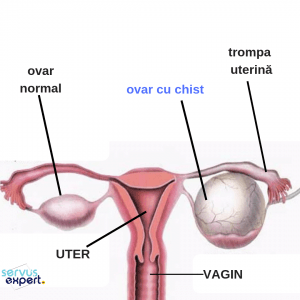 suspectat de chist ovarian stâng hipermetropia este atunci când plus sau minus