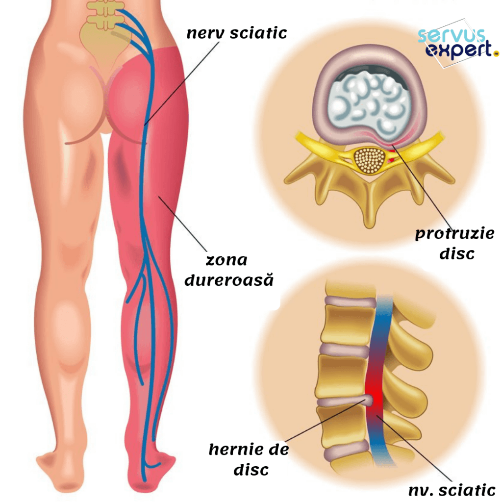 dureri de sold nervul sciatic dureri de genunchi cu schimbarea vremii