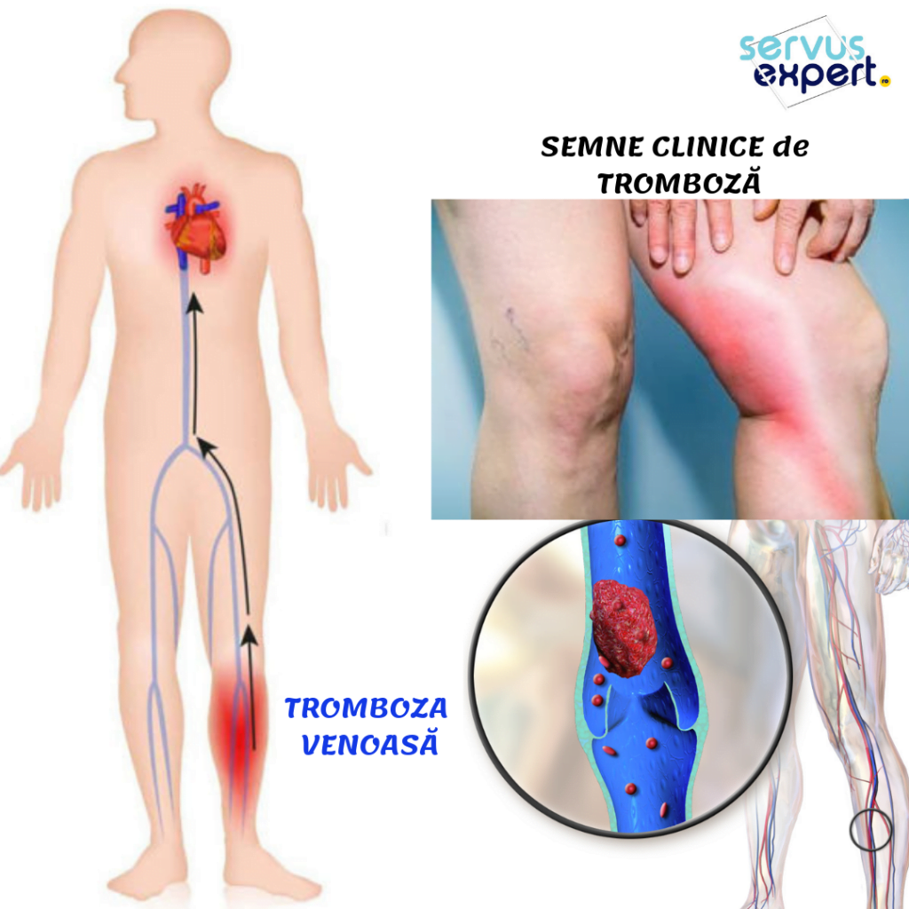 Cheaguri de sânge la nivelul piciorului: Cauze și simptome - Sănătate Non-Stop
