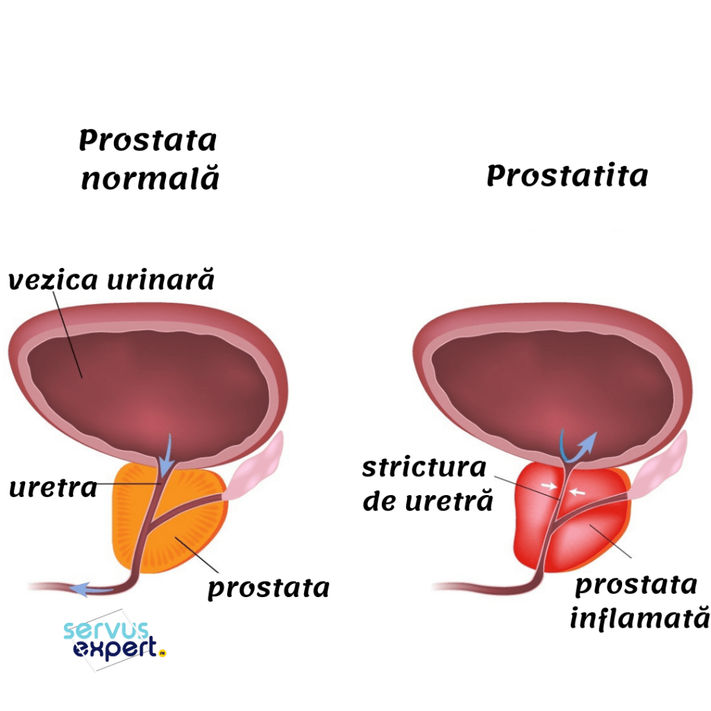 prostatită cronică disfuncție erectilă penis curbat în timpul erecției