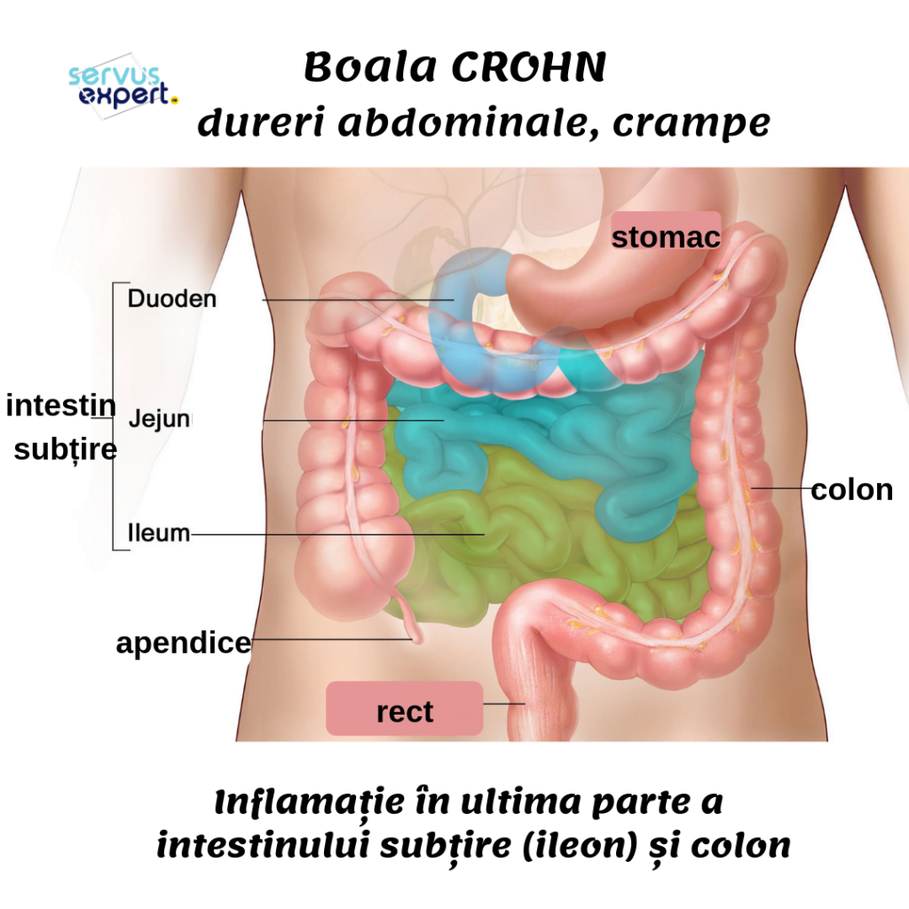 Leziunile articulare ale bolii Crohn)