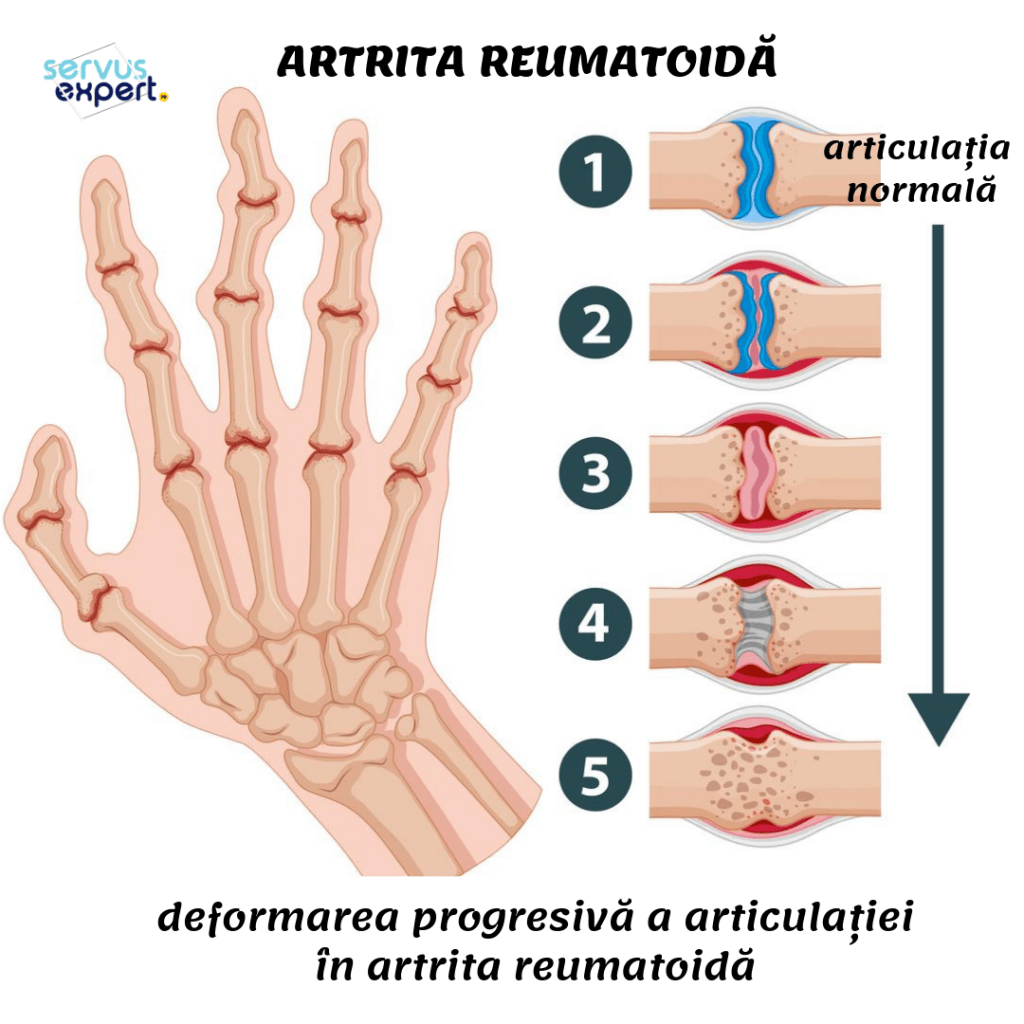 tratamentul artritei deformante a mâinilor