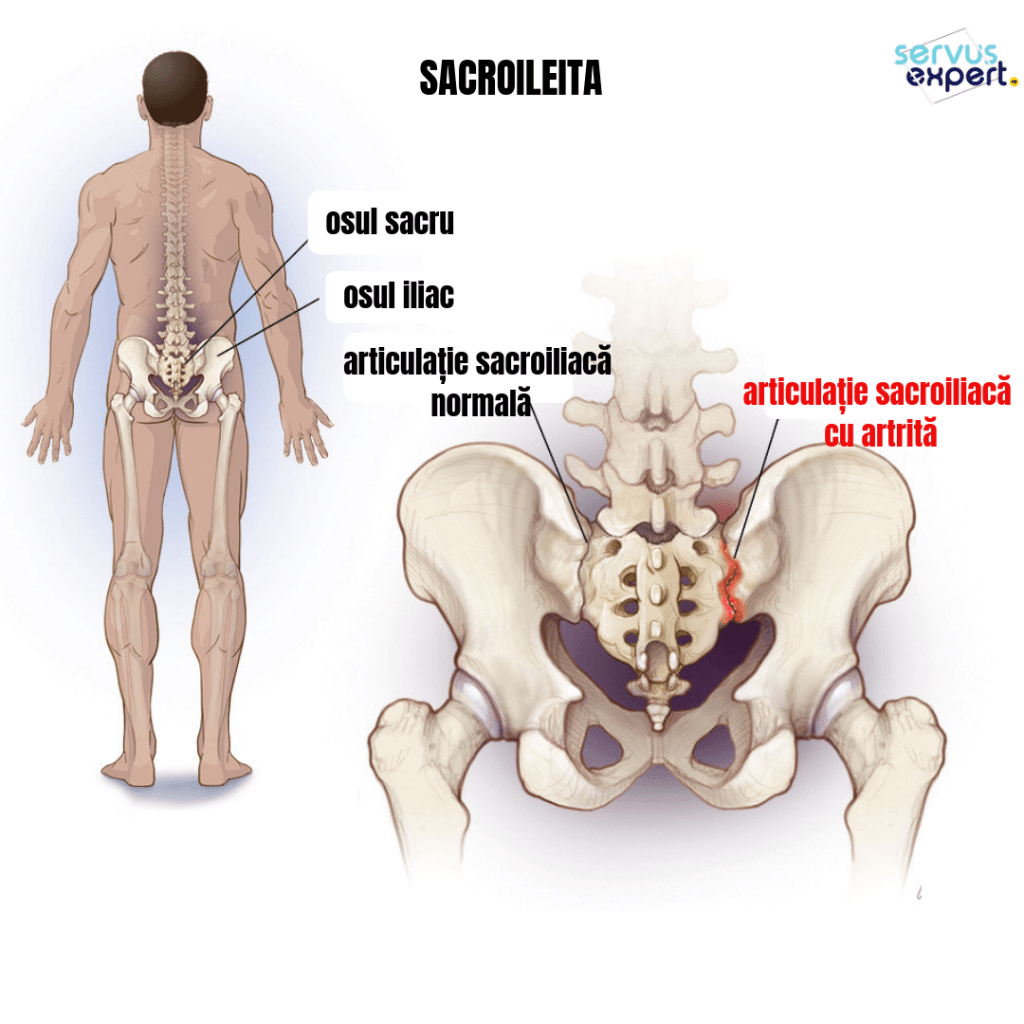 dureri la nivelul articulațiilor spatelui și șoldului