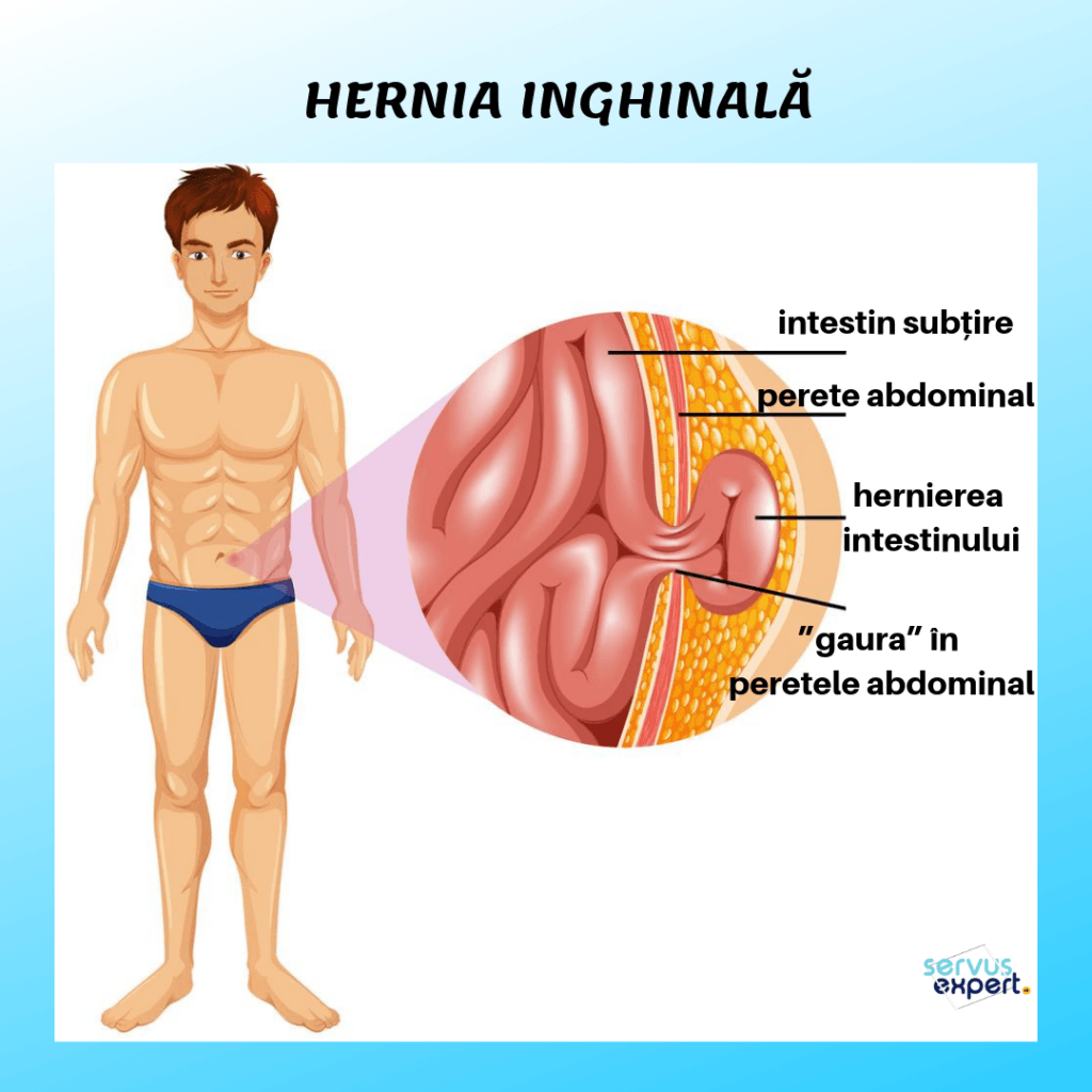 Hernia inghinala - cauze, simptome, tratament, complicatii