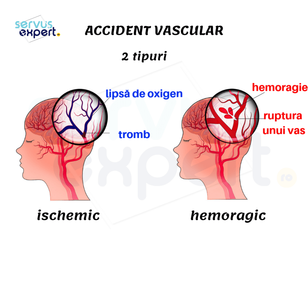 accident vascular cerebral minus 2 75 viziune
