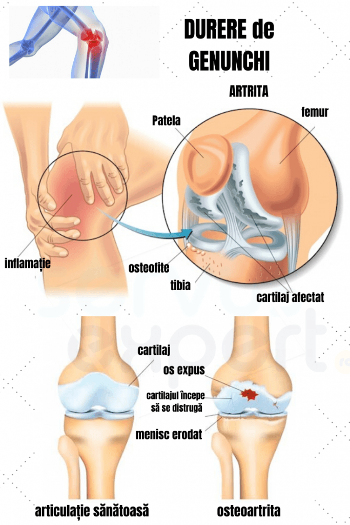 de ce se pot răni articulațiile genunchiului)