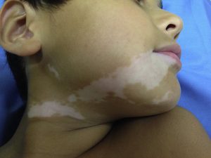 vitiligo și tiroida