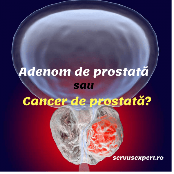 Adenom de prostata