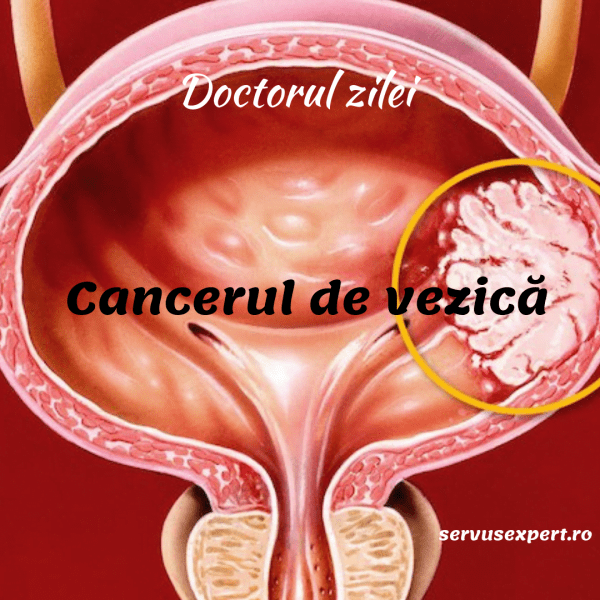 cancerul vezicii urinare cancer de col uterin cu virus papilom