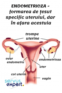 endometrioza, uter, țesut endometriozic
