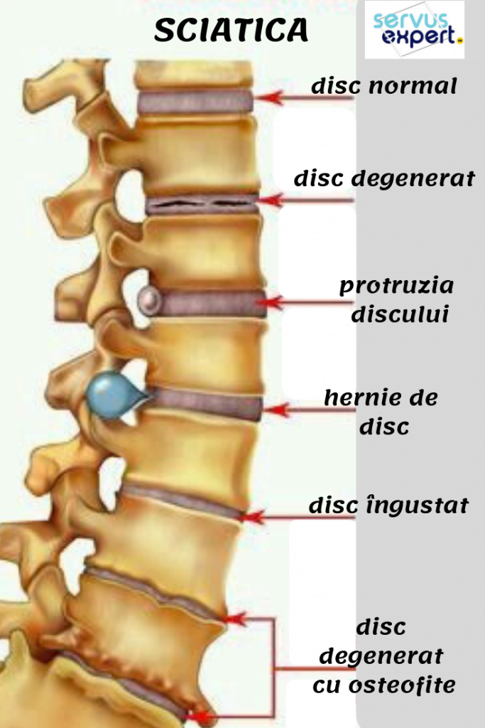 Hernia coloanei vertebrale: metoda de tratament a doctorului Bubnovsky