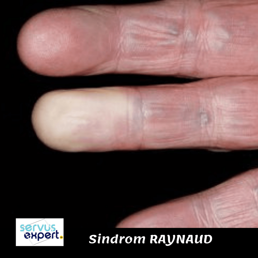 sindrom Raynaud - degete amorțite și reci