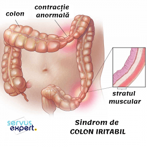 colon iritabil