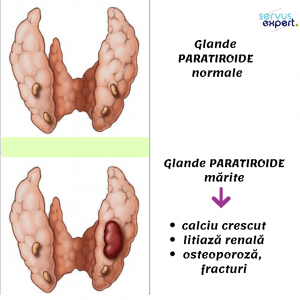 glandele paratiroide și litiaza renală