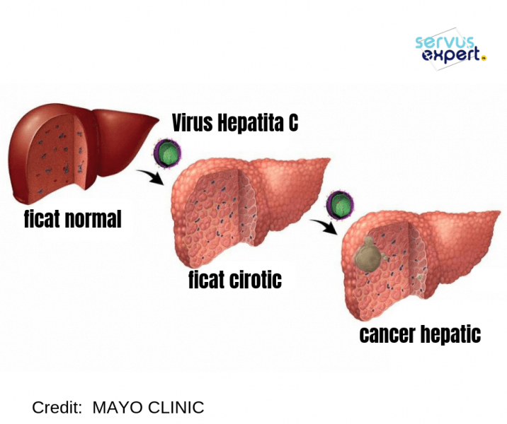hepatita C, Ciroza, Cancer hepatic