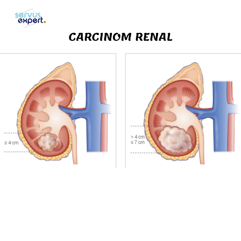 cancer renal