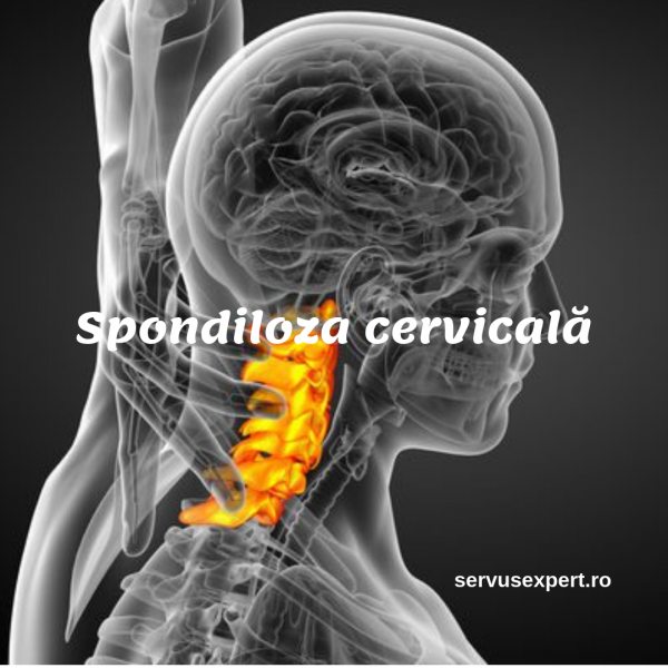 Spondiloza cervicala – cauze, simptome, tratament