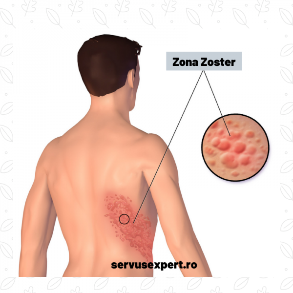 zona zoster