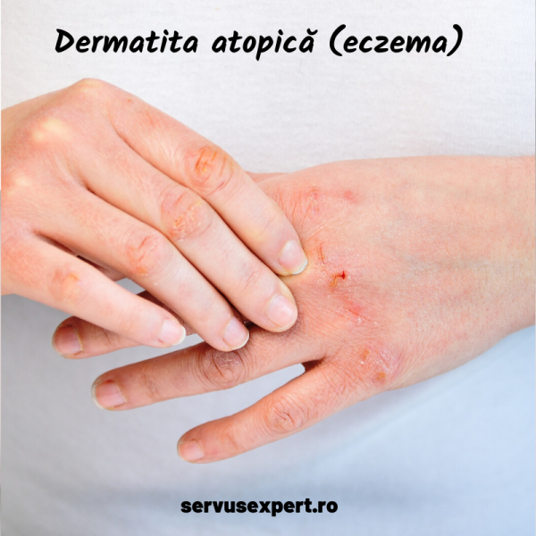 eczema (dermatita atopică)