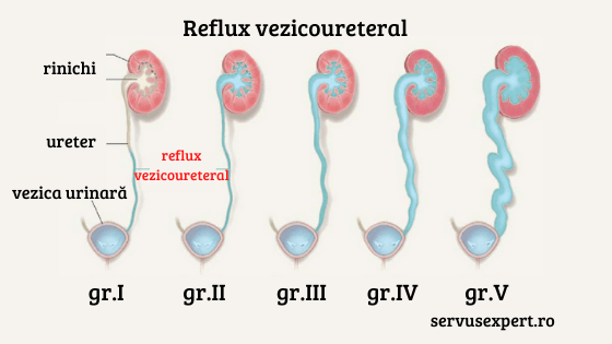 reflux vezicoureteral la copii