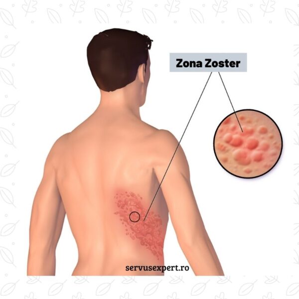 herpes zoster sau zona zoster