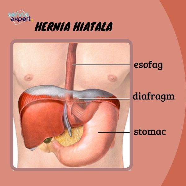 Hernia hiatala si esofagita de reflux - Dr. Victor Radu