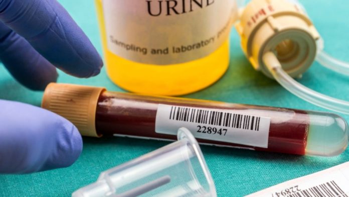 urina cu sange sau hematuria