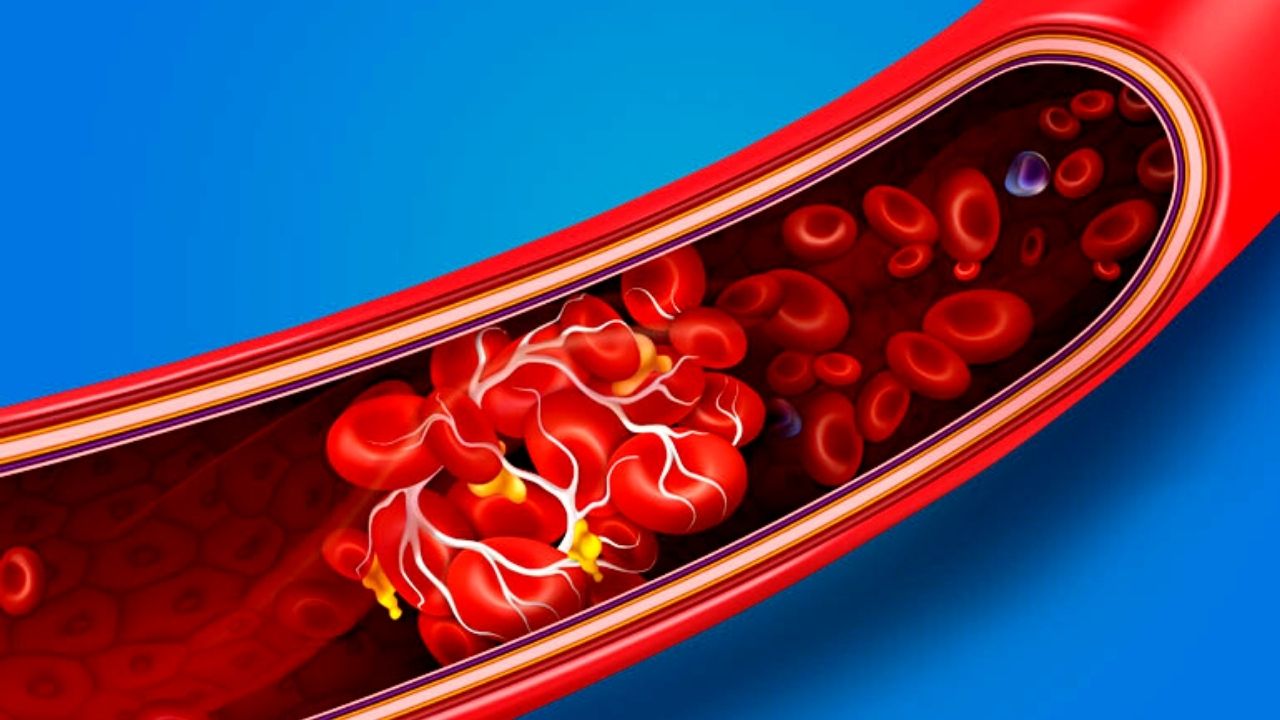 Cum se dizolvă cheagurile de sânge folosind medicamente și alte metode