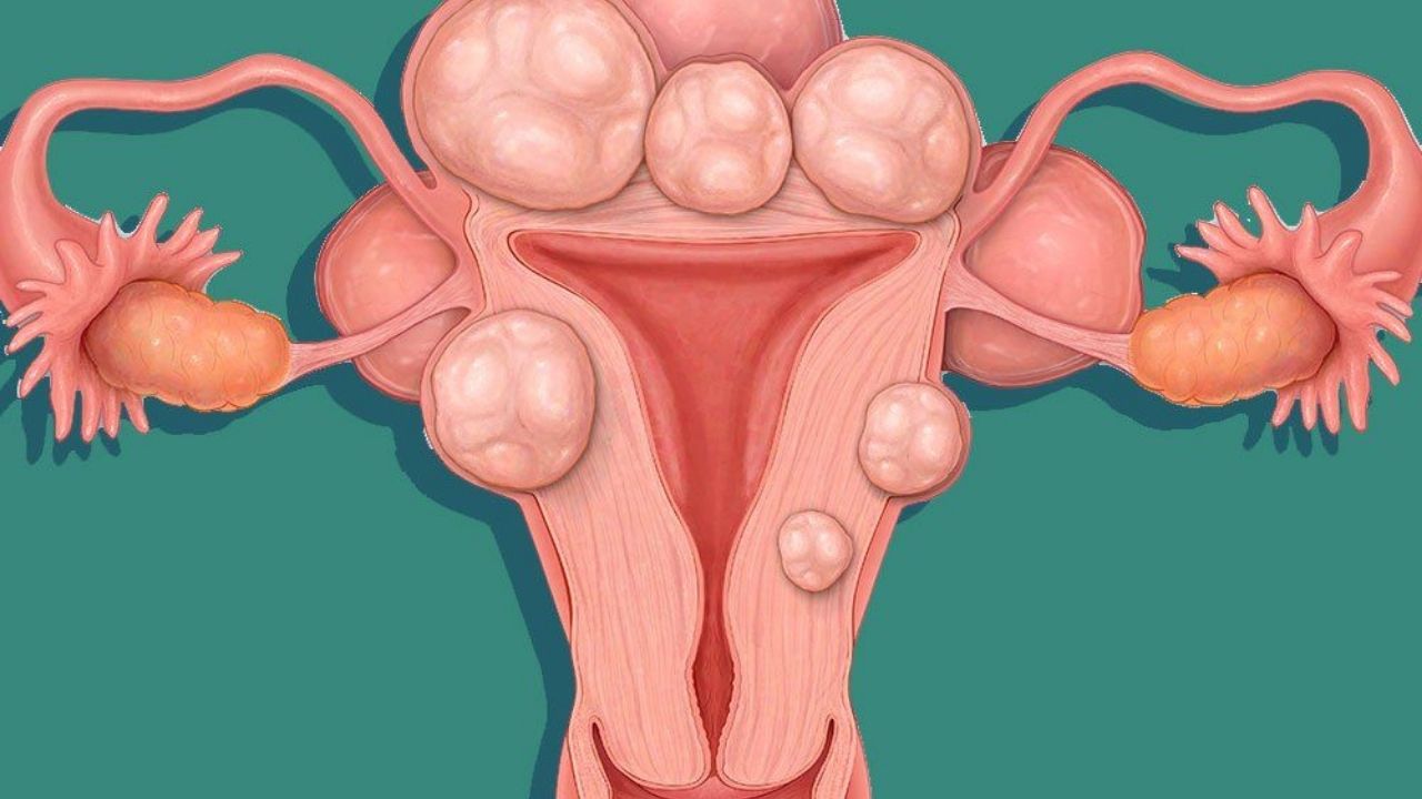 Ce este fibromul uterin si cand trebuie operat?