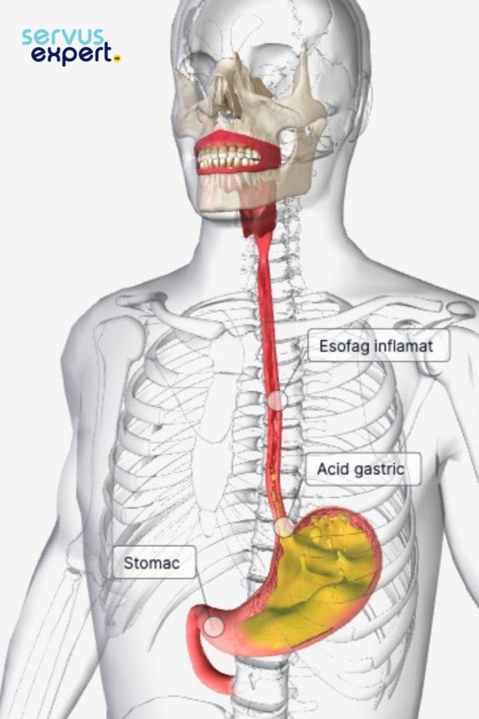 esofagita de reflux, stomac
