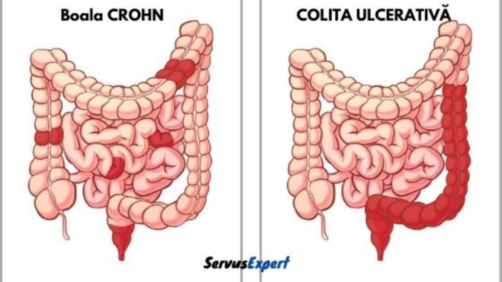 boala crohn vs colita ulcerativa