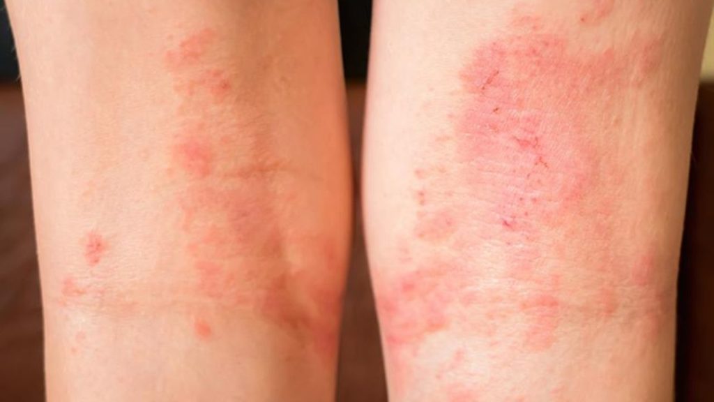 alergie alimentara eczema