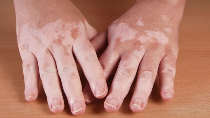 ruxolitinib tratament pentru vitiligo