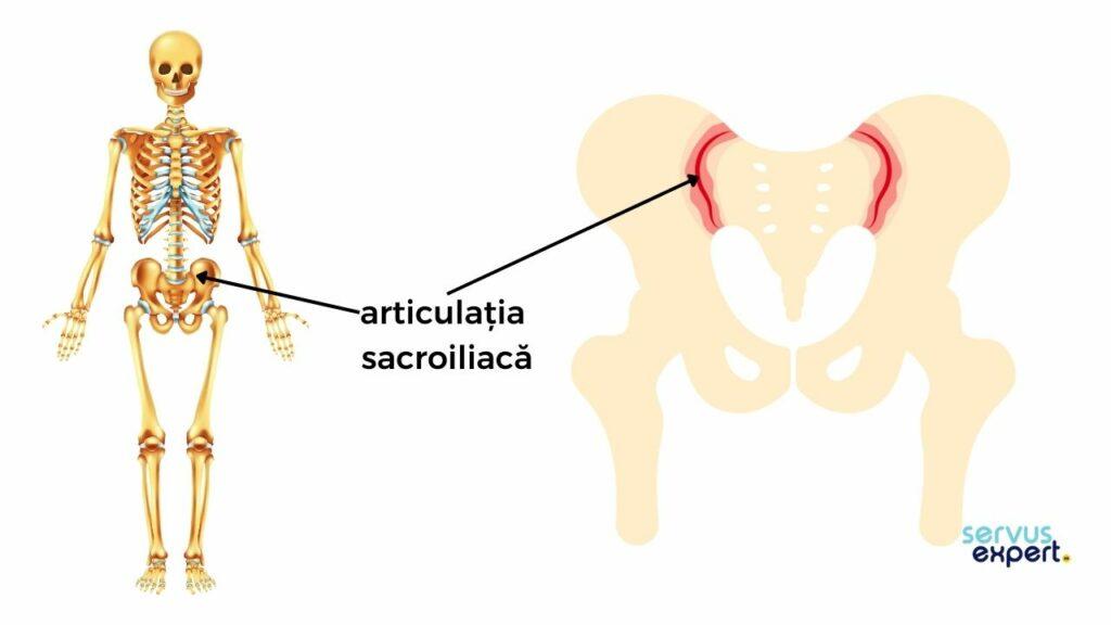 sacroileita